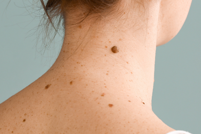 New AI system redefines how skin cancer is identified, managed, and treated